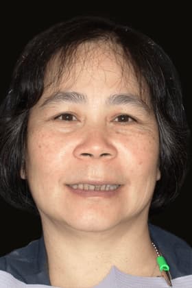 Before and after smile transformation by Advanced Dental Implant and TMJ Center in Southaven, MS.